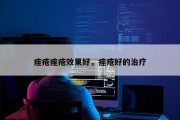 痤疮痤疮效果好，痤疮好的治疗